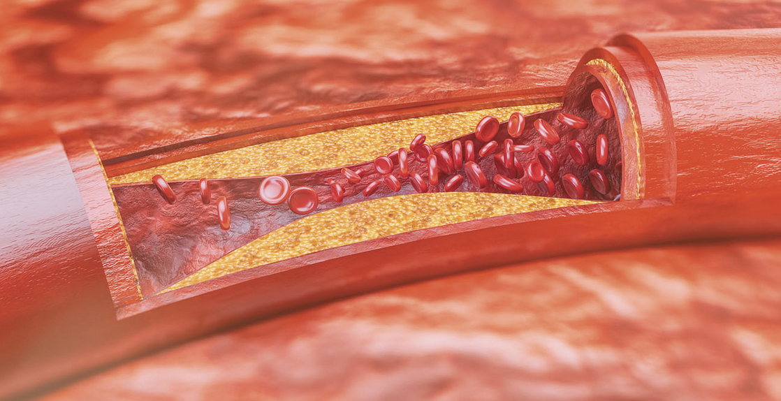 Plaque Atherosclerosis How To Remember Phartoonz