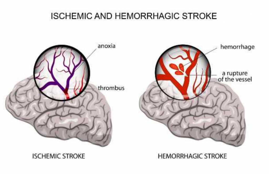 stroke-types-symptoms-and-long-term-outlook-1md-nutrition